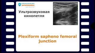 Plexiform sapheno femoral junction [upl. by Ianteen]