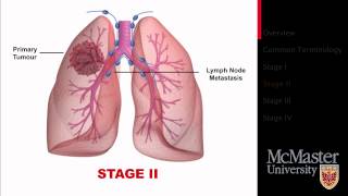 Lung Cancer Staging Presentation [upl. by Namyw]