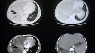 CT of Complex Pleural Parenchymal Disease [upl. by Anirod]