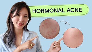 How To Treat Hormonal Acne  Acne School EP03 Health [upl. by Liddie]