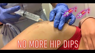 Pt2 Sculptra Update HIP INJECTIONS🍑💉💉 [upl. by Aleusnoc]