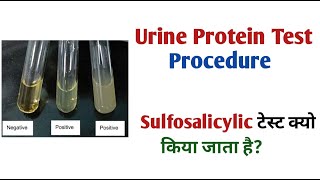 urine protein test manual procedure I urine protein test report [upl. by Fe]