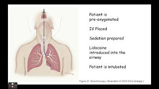 Bronchoalveolar Lavage 2023 [upl. by Christean827]