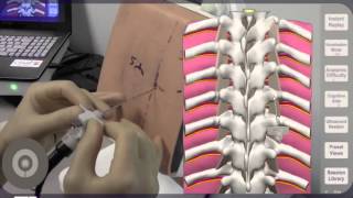 Needle Angulation for Thoracic Paravertebral Block TPVB [upl. by Ielirol206]