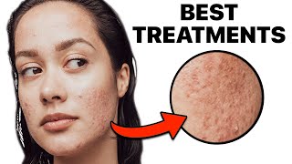 How To Get Rid of Acne Scars [upl. by Asyl594]