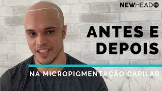 Antes e depois na Micropigmentação Capilar Nicolas [upl. by Malinde]