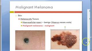 Pathology 763 b Malignant Melanoma Gross Morphology Lentigo Acral lentigenous desmoplastic maligna [upl. by Aduh]