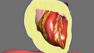 Pericardiocentesis in Pericardial Effusion and Cardiac Tamponade Animation by Cal Shipley MD [upl. by Karlie]