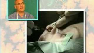 Estetska operacija nosa nose surgery Dr Glusac [upl. by Nevile]