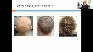 Alopecia Areata Treatment Update 2024 [upl. by Ehcar]