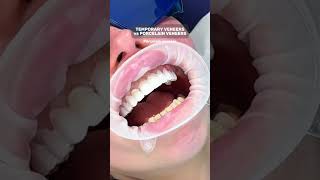 Temporary Veneers vs Porcelain Veneers  Cosmetique Dental [upl. by Dardani]