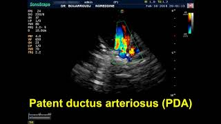 Patent ductus arteriosus PDA echocardiography [upl. by Sophi]