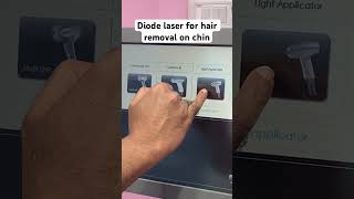 Diode laser for hair removal on chin Dermatology [upl. by Kristyn]