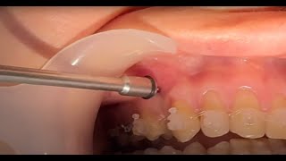 Mini screw mini implant insertion  screwing in orthodontic miniimplant TAD [upl. by Francoise31]