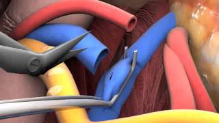 Lecture 26 Kidney transplant surgery [upl. by Enelrac525]