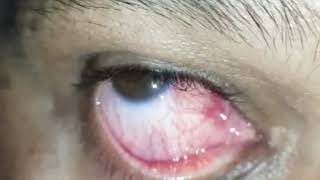 Episcleritis Ophthalmology clinical signs shorts [upl. by Asille]