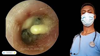 🔴Antenna fungi ear wax cleaning earearwax earwaxremovalearwaxcleaning [upl. by Walden472]