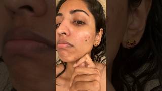 Extreme Skin Reaction to BENZOYL PEROXIDE Acne Treatment 😱 SkinCareFail benzoylperoxide [upl. by Ragg]