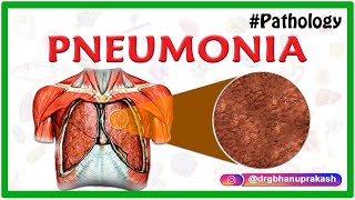 PNEUMONIA  PATHOLOGY ANIMATED VIDEO LECTURE [upl. by Yeca878]