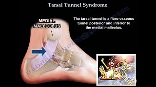 Tarsal Tunnel Syndrome  Everything You Need To Know  Dr Nabil Ebraheim [upl. by Immas396]