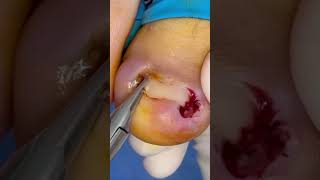 Checking on my patient before removing a MASSIVE ingrown toenail Click the link to 👀 the full video [upl. by Eletnahs888]