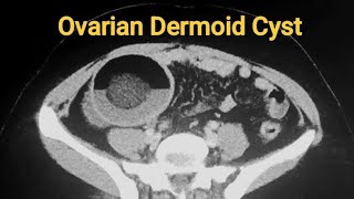 Ovarian Dermoid Cyst [upl. by Earezed132]