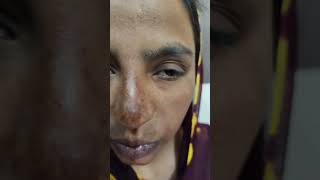 Melasma Chloasma Treatment Dr Ahsan Ahmad Skin Care Clinic Call 91 7417928805 [upl. by Favata]