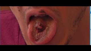 Mans Vaping Device Explodes  Blows Fleshy Hole in His Tongue [upl. by Hamford]