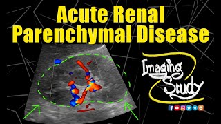 Acute Renal Parenchymal Disease  Ultrasound  Case 181 [upl. by Dilisio]