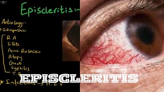 Episcleritis  Aetiology  pathogenesis  clinical features  treatment [upl. by Welsh]