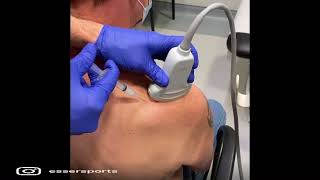 Shoulder Hydrodistention [upl. by Godwin]