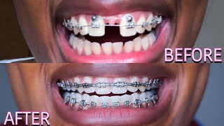 Full Braces Journey Time Lapse  3 Years Gaps Overbite Frenectomy  Starring Shameka [upl. by Jaela]