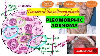 Pleomorphic Adenoma  Salivary gland tumors  DETAILED Textbook discussion Shafers  NEET MDSNBDE [upl. by Hennessy]