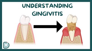 Understanding Gingivitis Causes Risk Factors Diagnosis and Treatment  Complete Guide [upl. by Ragland]