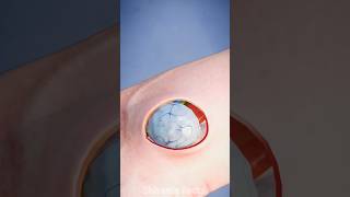 How to fix Ganglion cyst 😲 [upl. by Oca386]