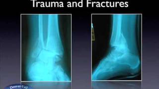 Treatment of Ankle Fractures [upl. by Sutherland]