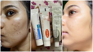 How to Remove Dark Spots and Get Clear Skin Pigmentation Dark Underarms Acne scars amp more [upl. by Elizabet115]