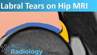 Labral Tears on Hip MRI [upl. by Alica]