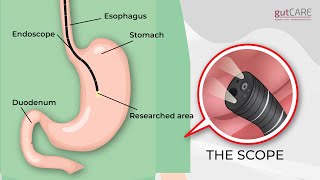 Preparing For Your Gastroscopy OGD  GUTCARE [upl. by Furtek946]