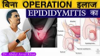 Epididymitis Treatment without Operation  Epididymitis Homeopathy Medicine in Hindi  epididymitis [upl. by Aieki]