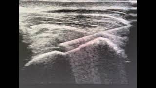 Ultrasound guided supraspinatus tendon injection [upl. by Schouten]