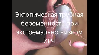 Эктопическая трубная беременность на УЗИ [upl. by Lamhaj]