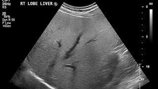 fatty liver ultrasound me kesa dikhta h GradeII fatty liver ka kya matlab hota h ultrasound me [upl. by Mcclish477]