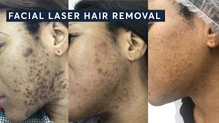 How to get rid of Ingrown hairs with Laser Hair Removal [upl. by Groome]