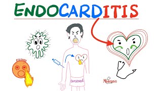 Infective Endocarditis  Fever amp New Murmur  Modified Duke’s Criteria  Cardiology Playlist [upl. by Antsirhc]