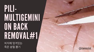 Pili multigemini removal from back [upl. by Levon]