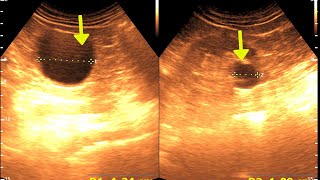 Three cases of renal Cortical Cyst  Kidney Cyst [upl. by Zellner]