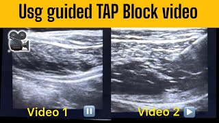 TAP BLOCK Ultrasound Video How to correctly find the correct plane  nervepainrelief [upl. by Akinirt]