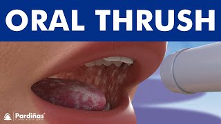 ORAL THRUSH  Candidiasis or yeast infection Angular cheilitis © [upl. by Artimid]