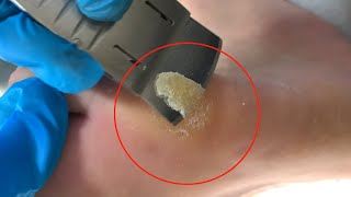 Callus removal from feetampFoot scraping dead skin【Xiao Yan pedicure】stress 914 [upl. by Stempien865]